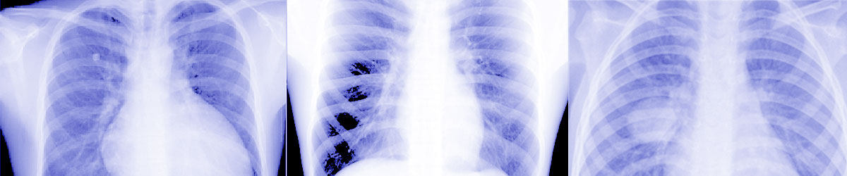 Detectos: Automated Abnormality Screening for Chest X-rays